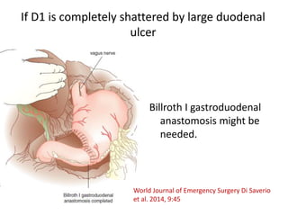 If D1 is completely shattered by large duodenal
ulcer
Billroth I gastroduodenal
anastomosis might be
needed.
World Journal of Emergency Surgery Di Saverio
et al. 2014, 9:45
 
