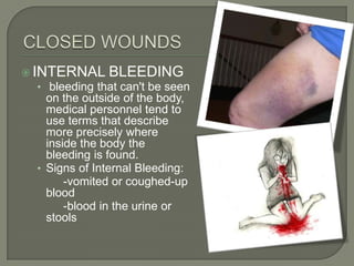  INTERNAL BLEEDING
• bleeding that can't be seen

on the outside of the body,
medical personnel tend to
use terms that describe
more precisely where
inside the body the
bleeding is found.
• Signs of Internal Bleeding:
-vomited or coughed-up
blood
-blood in the urine or
stools

 