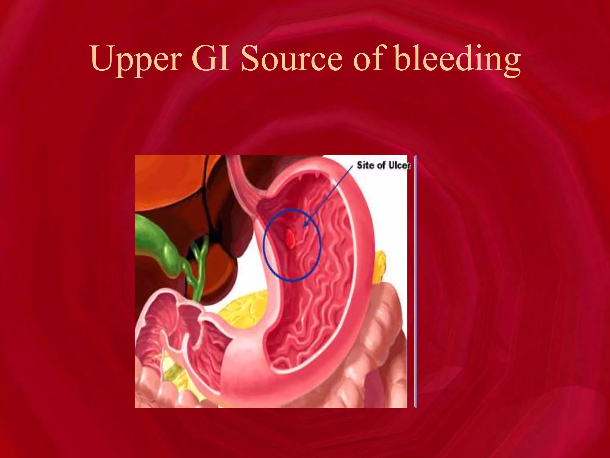 Upper GI Source of bleeding
 