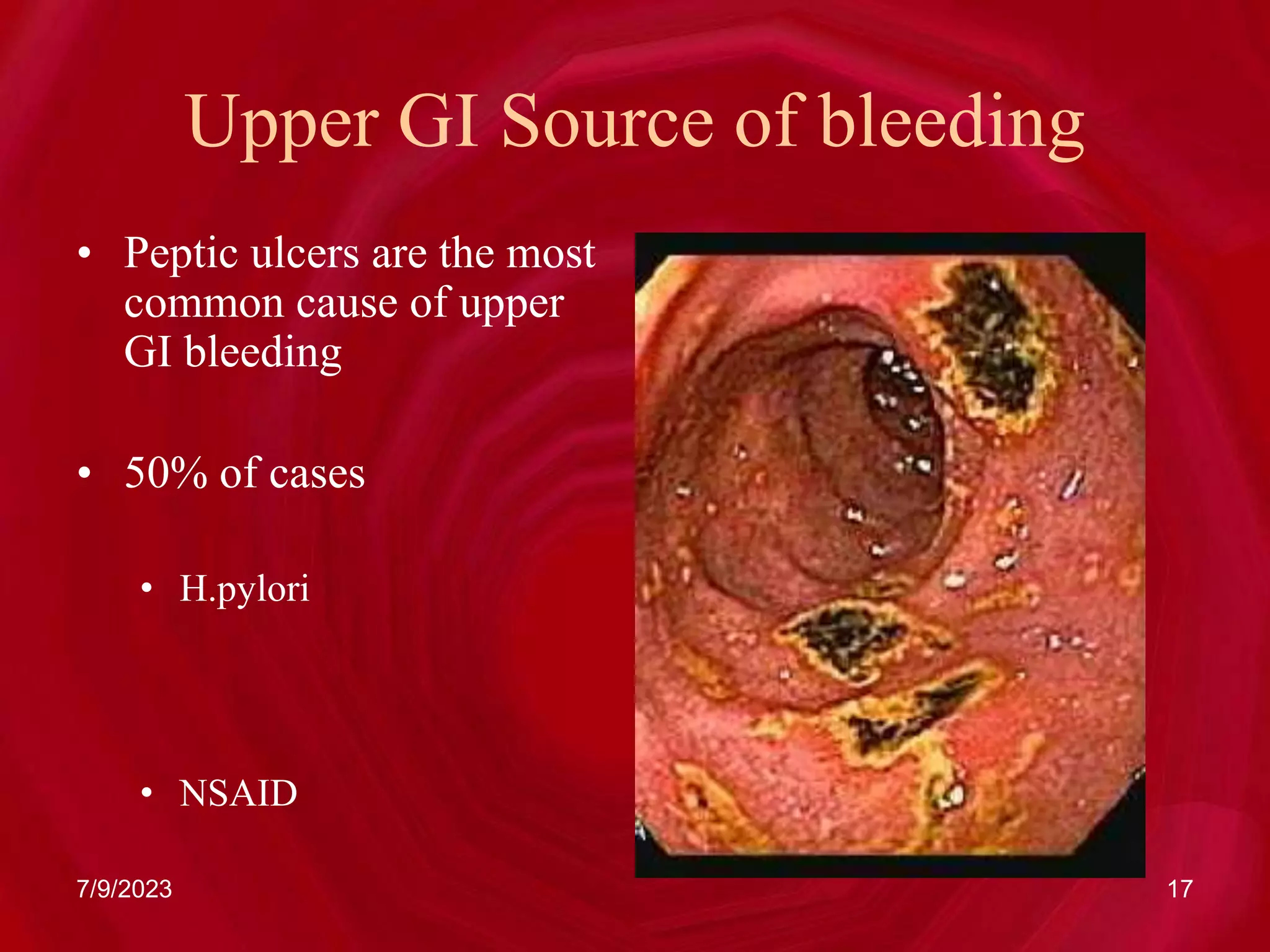 Upper GI Source of bleeding
• Peptic ulcers are the most
common cause of upper
GI bleeding
• 50% of cases
• H.pylori
• NSAID
7/9/2023 17
 
