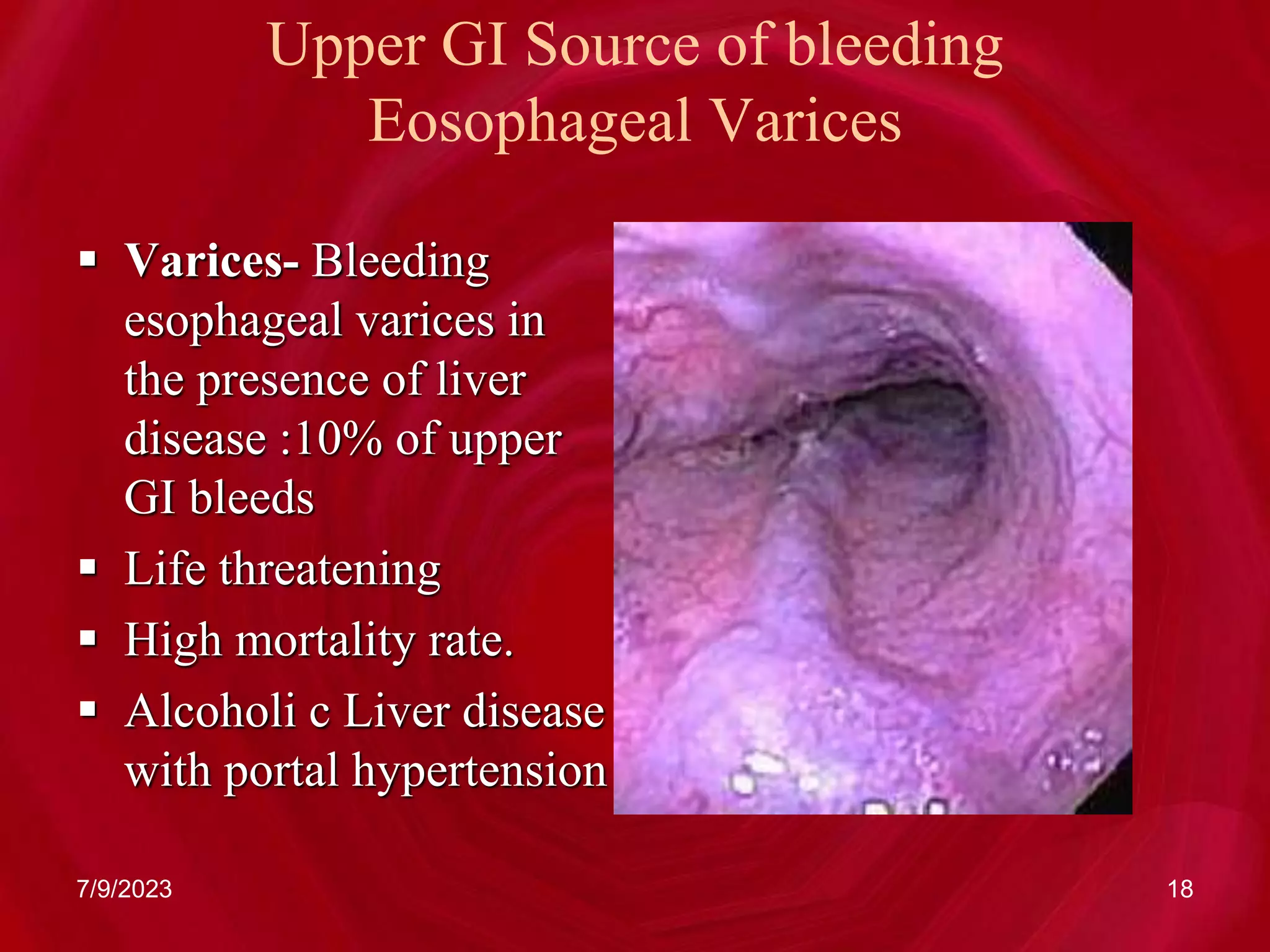 Upper GI Source of bleeding
Eosophageal Varices
 Varices- Bleeding
esophageal varices in
the presence of liver
disease :10% of upper
GI bleeds
 Life threatening
 High mortality rate.
 Alcoholi c Liver disease
with portal hypertension
7/9/2023 18
 