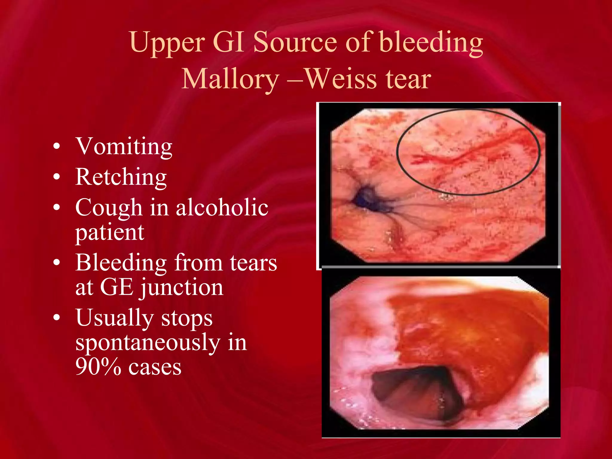 Upper GI Source of bleeding
Mallory –Weiss tear
• Vomiting
• Retching
• Cough in alcoholic
patient
• Bleeding from tears
at GE junction
• Usually stops
spontaneously in
90% cases
 