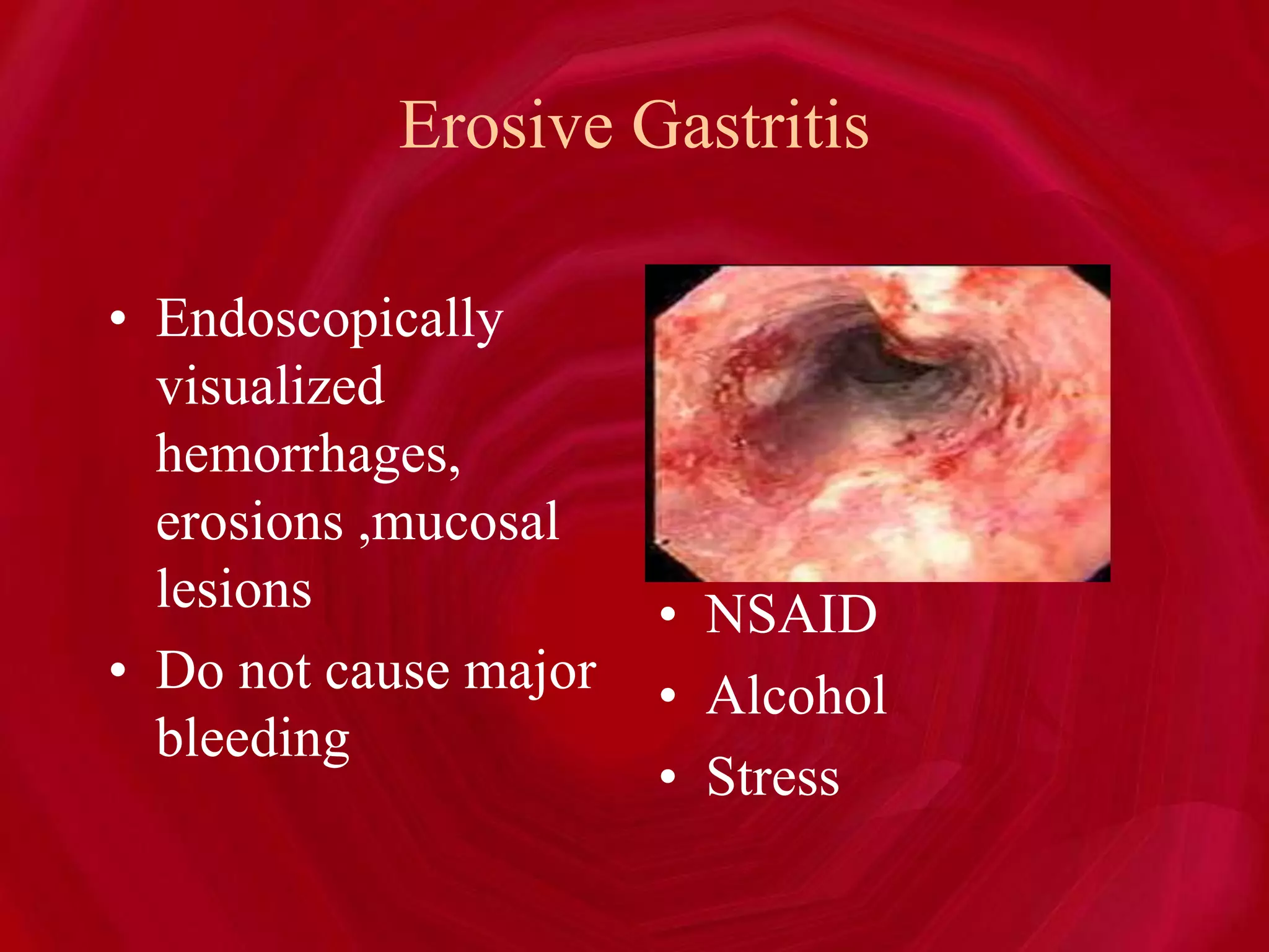 Erosive Gastritis
• Endoscopically
visualized
hemorrhages,
erosions ,mucosal
lesions
• Do not cause major
bleeding
• NSAID
• Alcohol
• Stress
 
