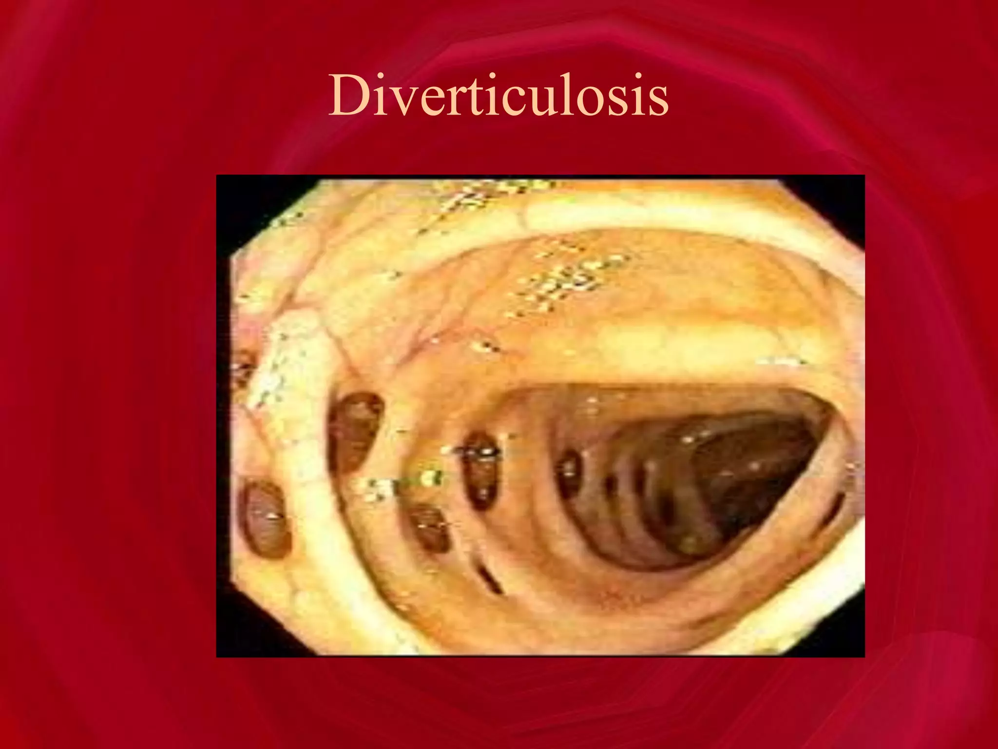 Diverticulosis
 