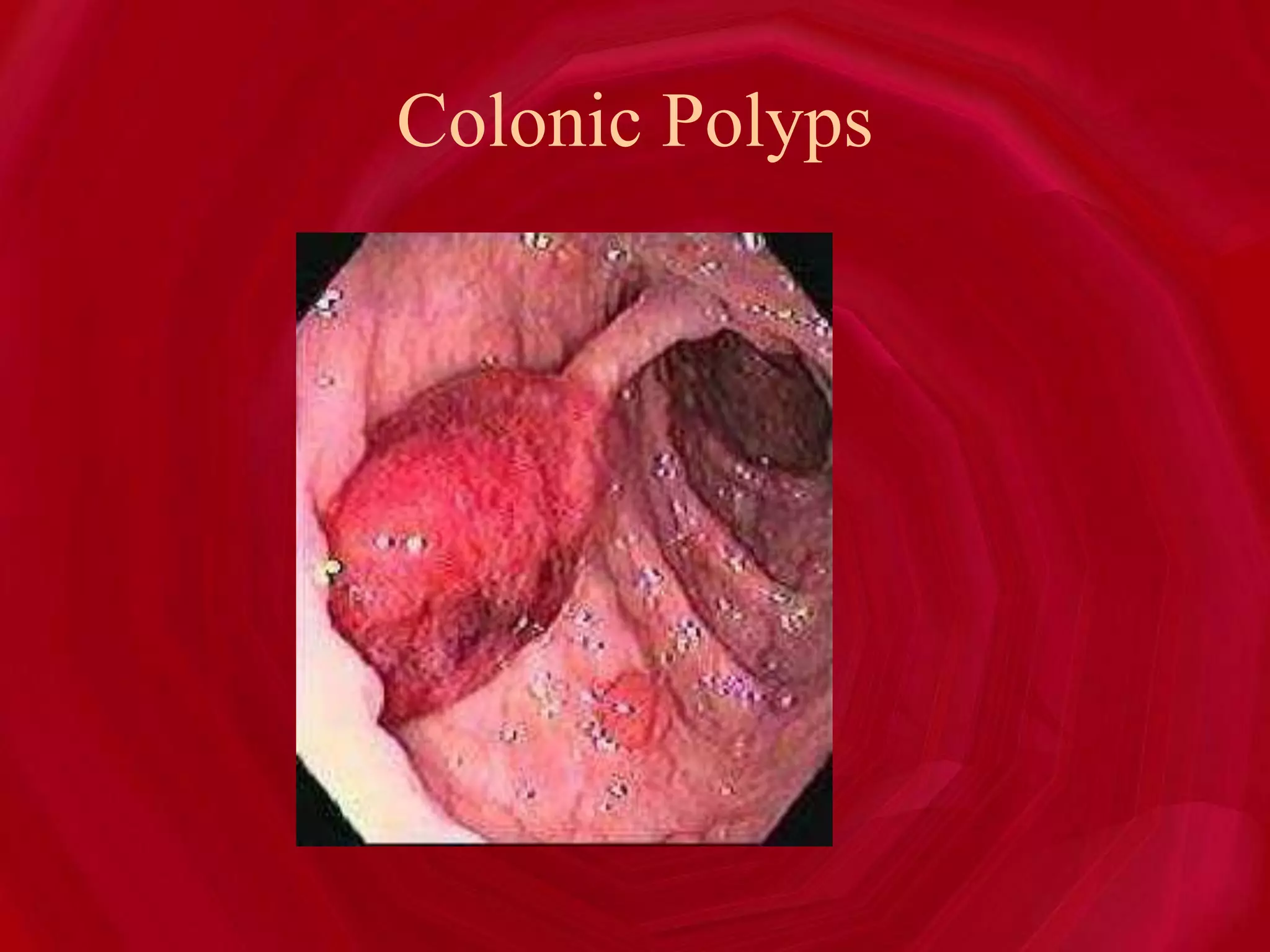 Colonic Polyps
 