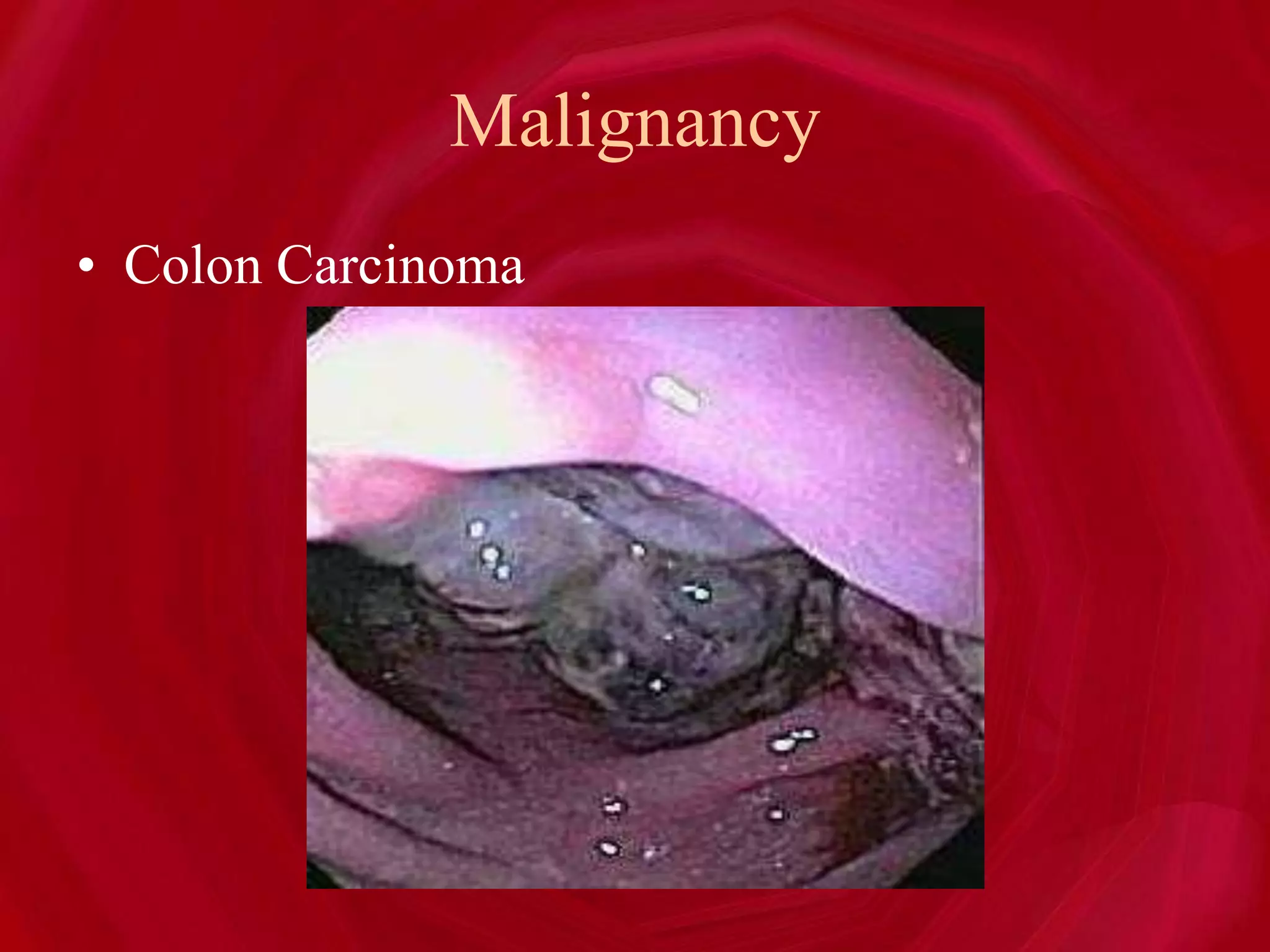 Malignancy
• Colon Carcinoma
 
