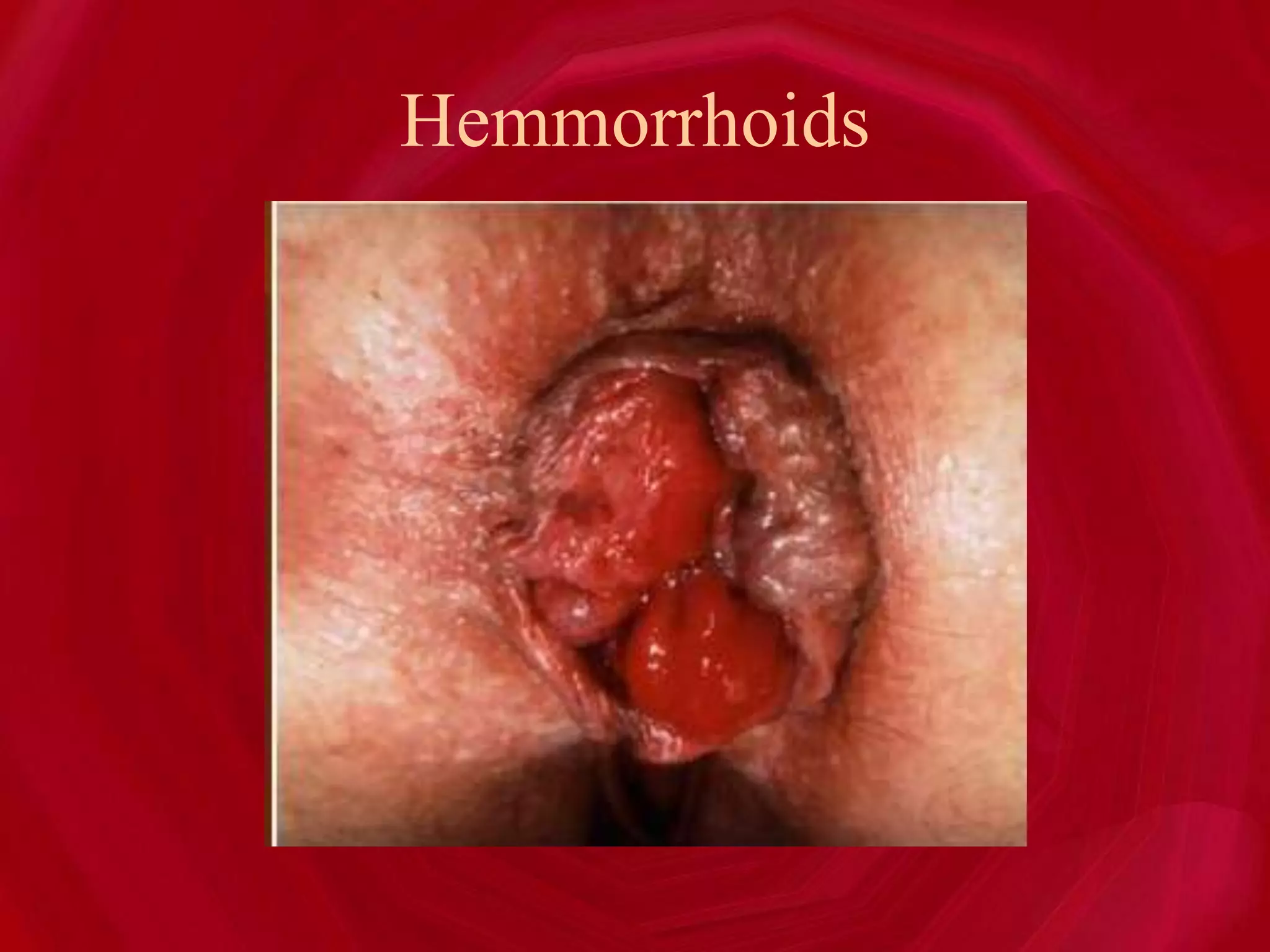 Hemmorrhoids
 