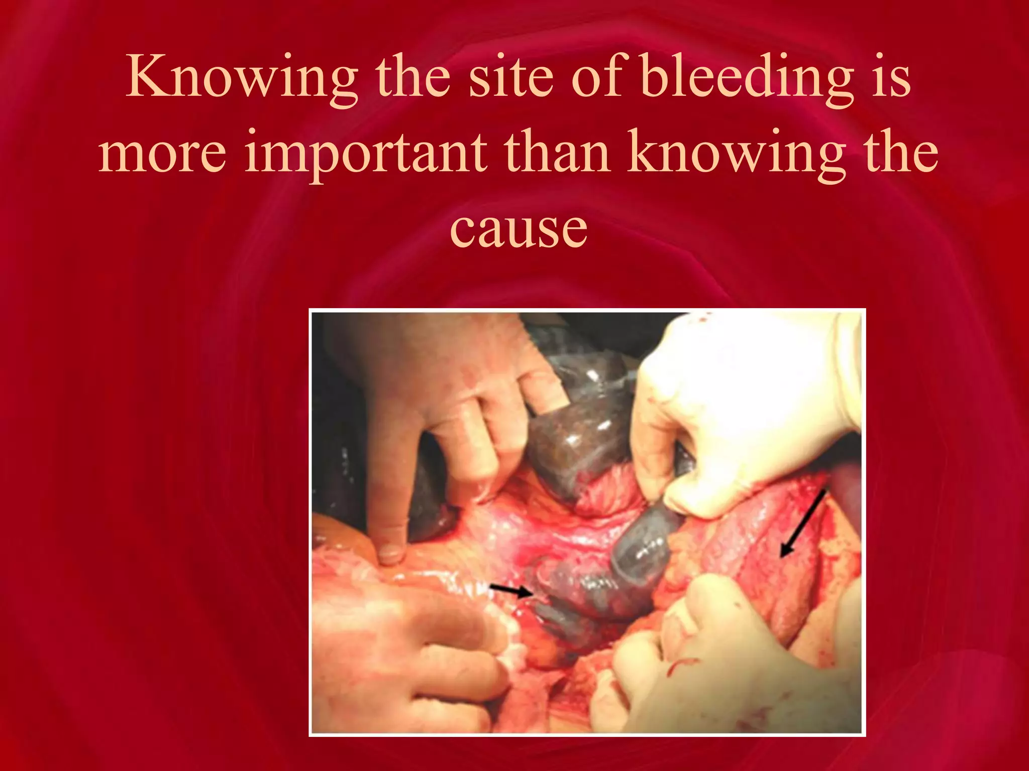 Knowing the site of bleeding is
more important than knowing the
cause
 