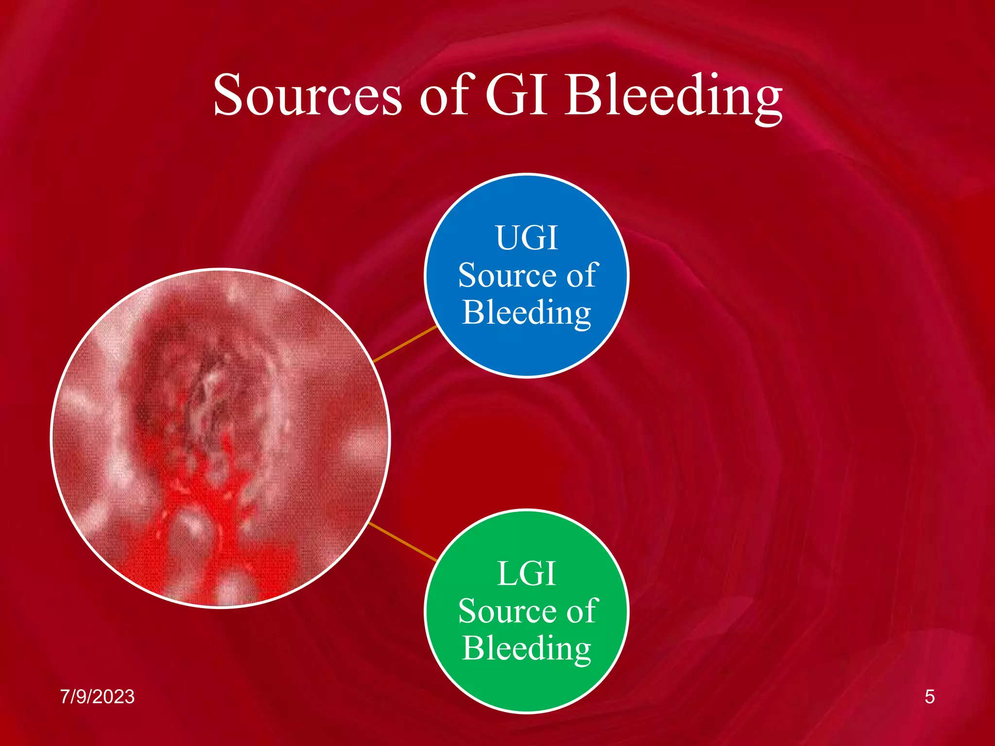 Sources of GI Bleeding
UGI
Source of
Bleeding
LGI
Source of
Bleeding
7/9/2023 5
 
