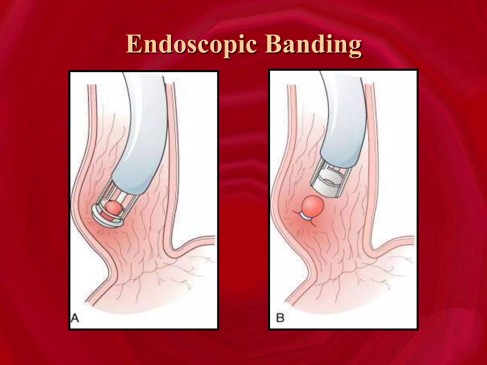Endoscopic Banding
 