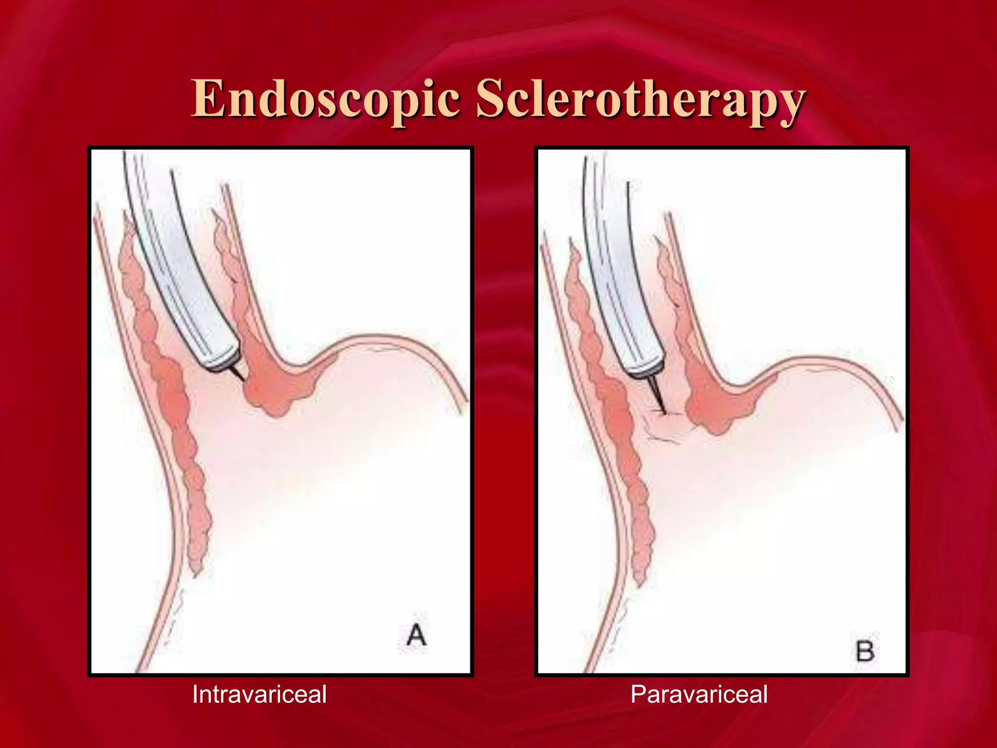 Endoscopic Sclerotherapy
Intravariceal Paravariceal
 