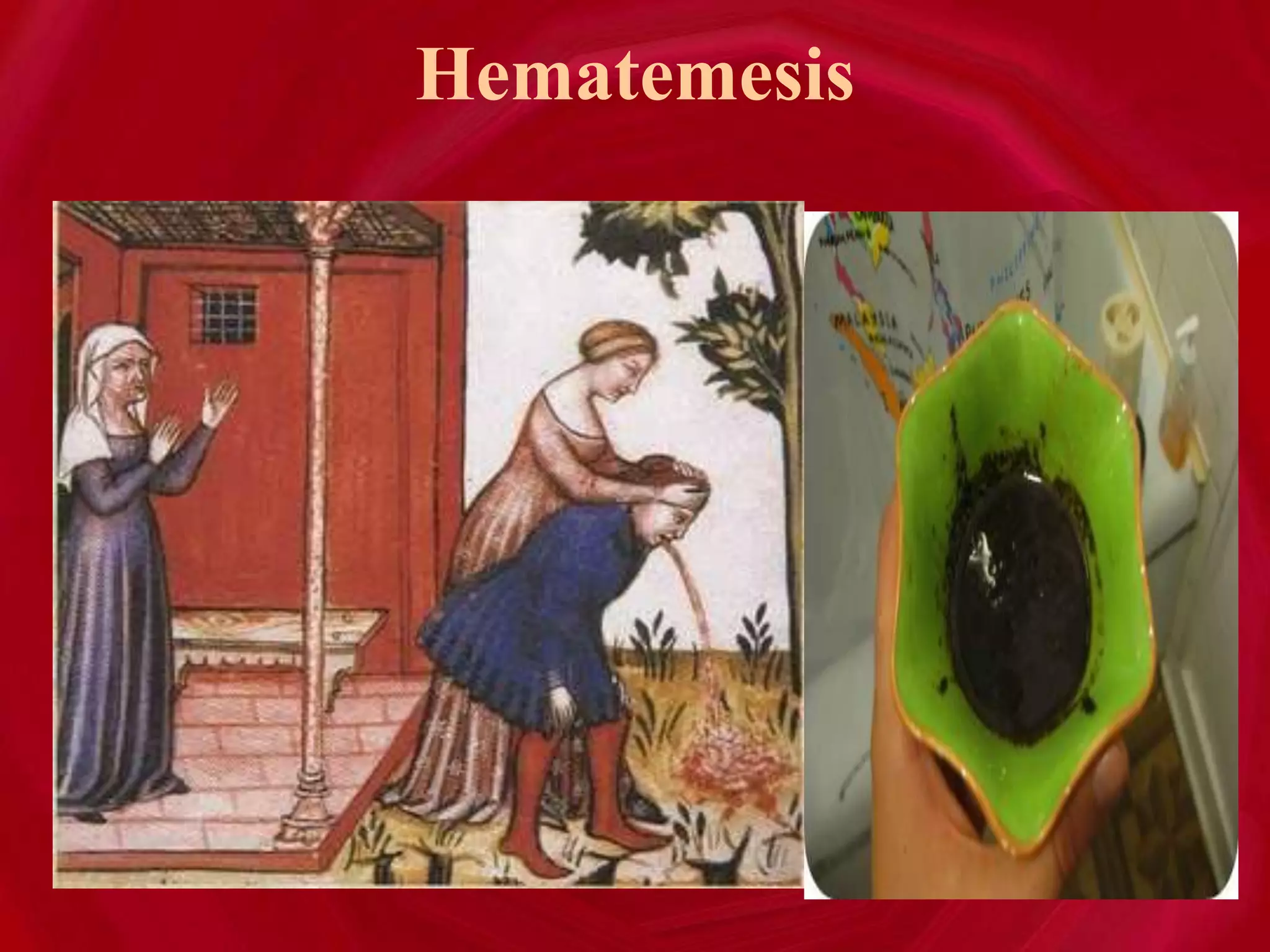 Hematemesis
 