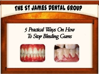 5 Practical Ways On How
 To Stop Bleeding Gums
 