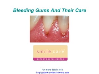 Bleeding Gums And Their Care For more details visit  http:// www.smilecareworld.com 