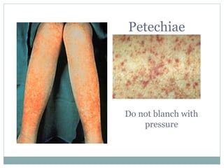 Petechiae
Do not blanch with
pressure
 