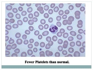 Fewer Platelets than normal.
 