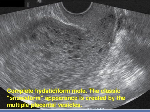 FIRST TRIMESTER BLEEDING