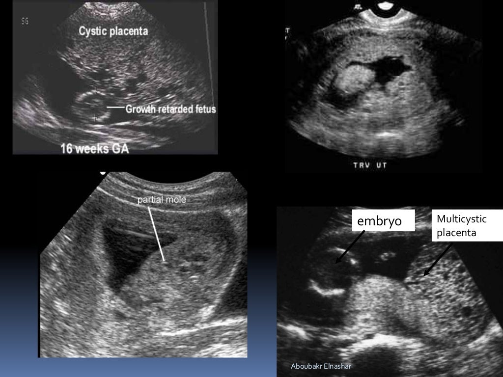 FIRST TRIMESTER BLEEDING