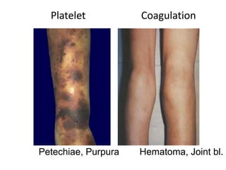 Platelet Coagulation
Petechiae, Purpura Hematoma, Joint bl.
 