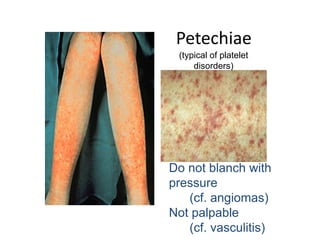 Petechiae
Do not blanch with
pressure
(cf. angiomas)
Not palpable
(cf. vasculitis)
(typical of platelet
disorders)
 