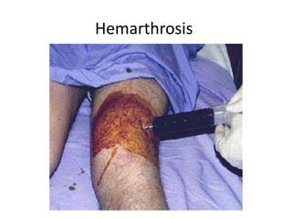 Hemarthrosis
 