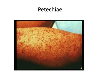 Petechiae
 