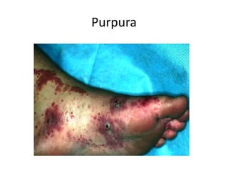 Purpura
 