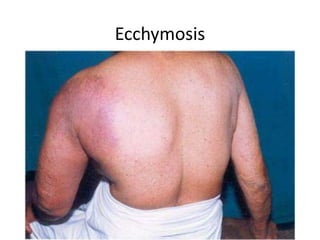 Ecchymosis
 