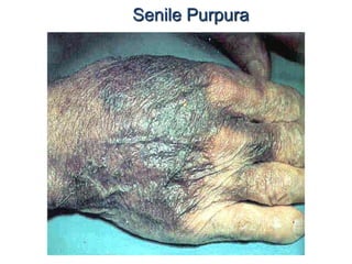 Senile Purpura
 