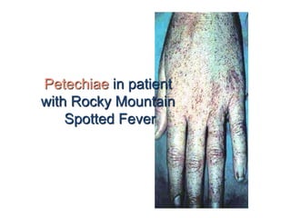 Petechiae in patient
with Rocky Mountain
Spotted Fever
 