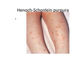 Henoch-Schonlein purpura
•
 