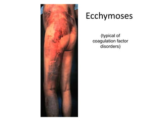 Ecchymoses
(typical of
coagulation factor
disorders)
 