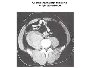 CT scan showing large hematoma
of right psoas muscle
 