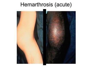 Hemarthrosis (acute)
 