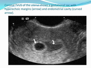 Coronal TVUS of the uterus shows a gestational sac with
hyperechoic margins (arrow) and endometrial cavity (curved
arrow).
 