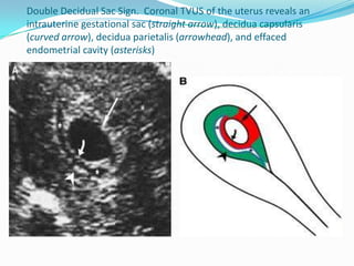 Double Decidual Sac Sign. Coronal TVUS of the uterus reveals an
intrauterine gestational sac (straight arrow), decidua capsularis
(curved arrow), decidua parietalis (arrowhead), and effaced
endometrial cavity (asterisks)
 