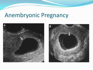 Anembryonic Pregnancy
 