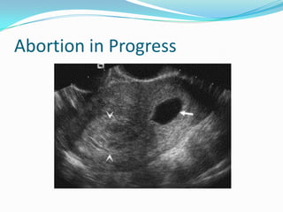 Abortion in Progress
 
