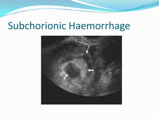 Subchorionic Haemorrhage
 