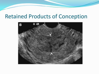 Retained Products of Conception
 