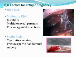 Risk Factors for Ectopic pregnancy
 High Risk

 Moderate Risk
  Infertility
  Multiple sexual partners
  Previous genital infections


 Slight Risk
  Cigarrette smoking
  Previous pelvic / abdominal
  surgery
 