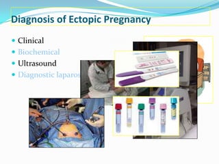 Diagnosis of Ectopic Pregnancy
 Clinical
 Biochemical
 Ultrasound
 Diagnostic laparoscopy ~ GOLD
                       STANDARD
 
