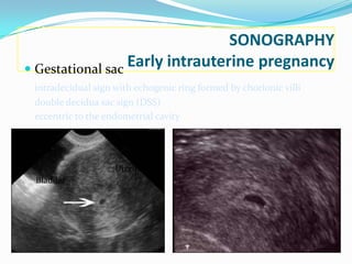 SONOGRAPHY
 Gestational sac
                  Early intrauterine pregnancy
 intradecidual sign with echogenic ring formed by chorionic villi
 double decidua sac sign (DSS)
 eccentric to the endometrial cavity




                    Uterus
 Bladder
 