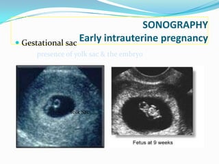 SONOGRAPHY
 Gestational sac
                  Early intrauterine pregnancy
     presence of yolk sac & the embryo




               Yolk Sac
 