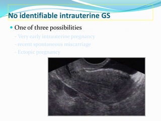 No identifiable intrauterine GS
 One of three possibilities
  - Very early intrauterine pregnancy
  - recent spontaneous miscarriage
  - Ectopic pregnancy
                                        Bladder

                         Cervix
                                            Uterus
 