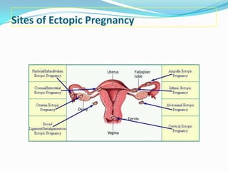 Sites of Ectopic Pregnancy
 
