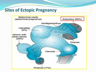 Sites of Ectopic Pregnancy
 
