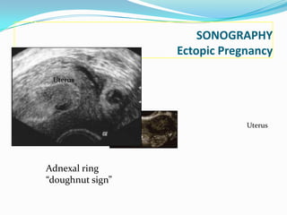 SONOGRAPHY
                  Ectopic Pregnancy

 Uterus




                              Uterus




Adnexal ring
“doughnut sign”
 