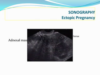 SONOGRAPHY
               Ectopic Pregnancy



                    Uterus
Adnexal mass




                 Mass
 