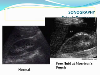 SONOGRAPHY
                     Ectopic Pregnancy

                 LIVER


LIVER
                                   Kidney

        Kidney




                 Free fluid at Morrison’s
                 Pouch
  Normal
 